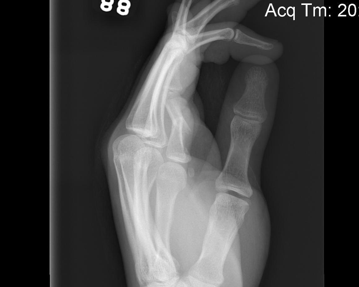 Finger Phalangeal Shaft Fracture Lateral